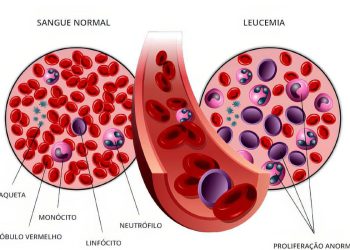 Anvisa autoriza pesquisa em pacientes com leucemia linfoide aguda B. Arte: Pfizer